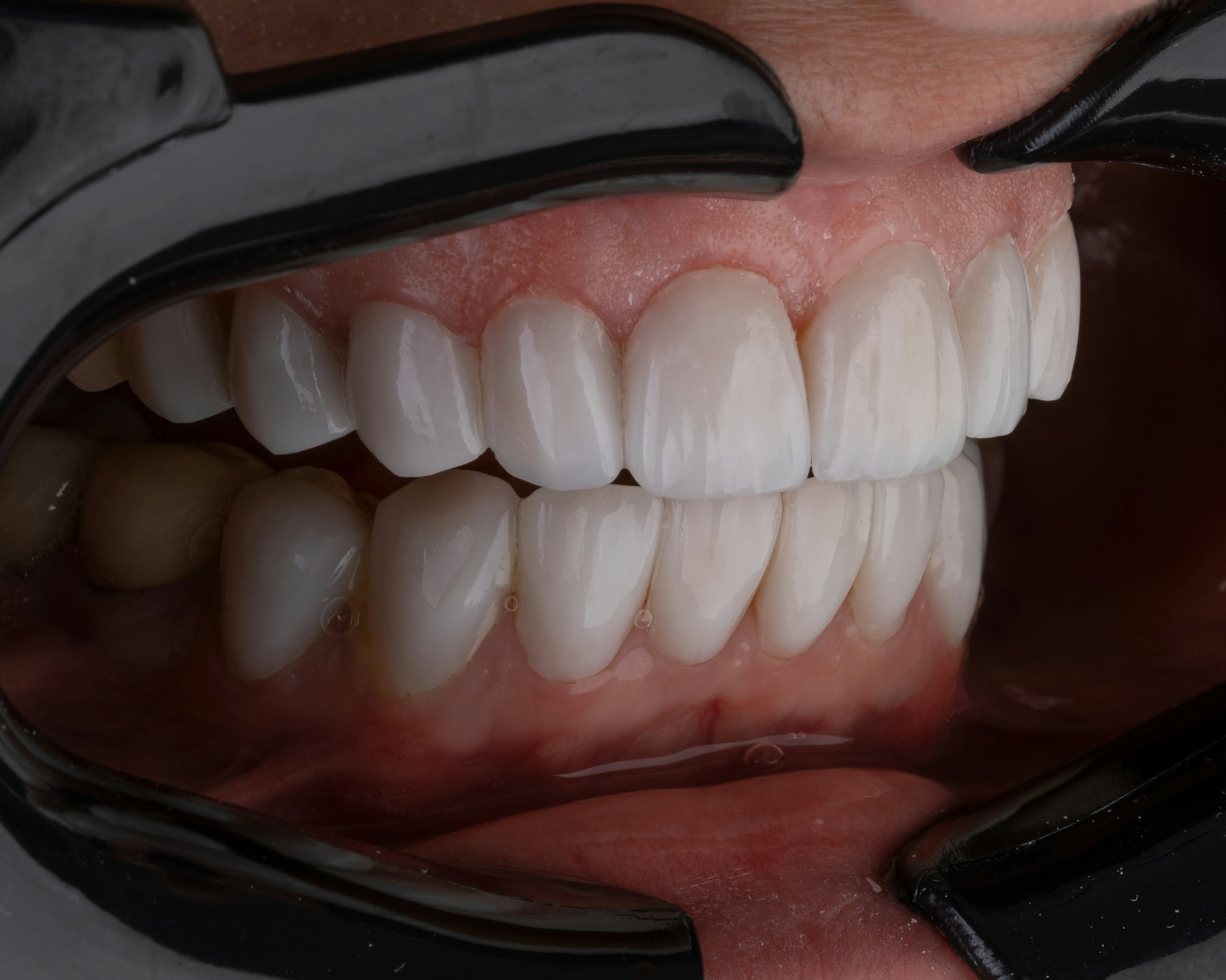whitening tandpasta