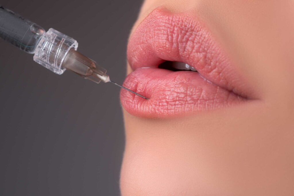 lip fillers