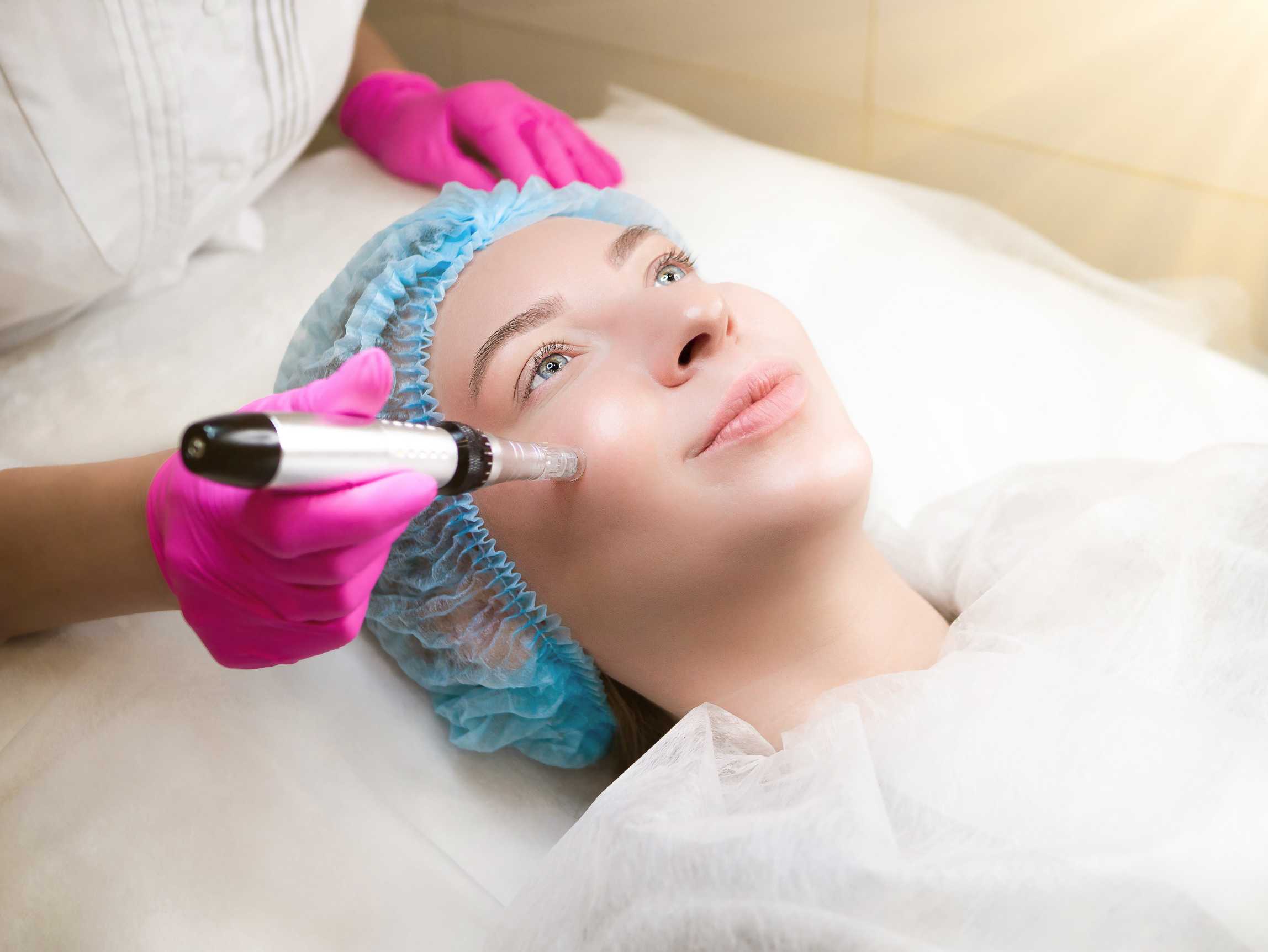 microneedling behandeling microneedling behandeling